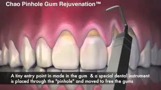 Raleigh Dentist Shares Chao Pinhole Gum Rejuvenation Animation - Receding Gums Treatment