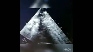Ultrasound guided ET tip confirmation