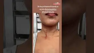 #PriyankaChopra gets #injured on the #sets of #TheBluff shares #pics of her #wound #bollywoodupdate