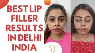Lip Filler Treatment in Delhi | Best Lip Augmentation Results in Delhi #Short