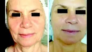 Virtual Gym and IREVIVE before and afters