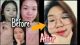 SOLUSYON SA PIMPLES?! l SKIN CARE ROUTINE I DANNICA BERNARDO
