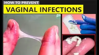 How To Stop Vaginal Yeast Infection & Itching | Vaginal Thrush Treatment | Is White Discharge Normal