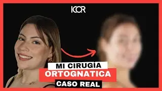 Testimonio Cirugía Ortognática Clase II + Prótesis + Ortodoncia.