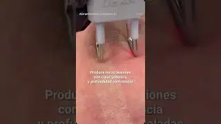 L&aacute;ser CO2 DEKA rejuvenecimiento facial #rejuvenecimientofacial #deka #co2 #skincare #laserfacial