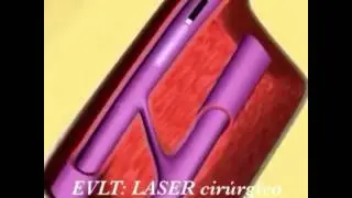 Cirurgia de veias Safenas a Laser