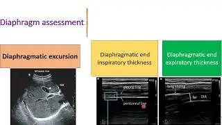 Functional Diaphragmatic assessment by US