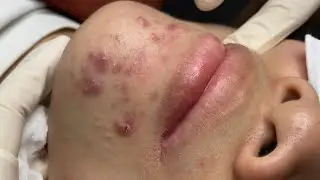 Why Blackheads Form | ASMR Deep Pore Cleansing#002 