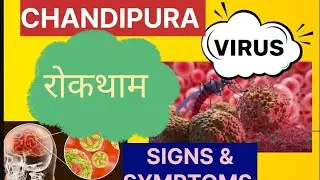 Chandipura Virus kya hai!Signs and symptoms #pediatrics #doctor #chandipuravirus