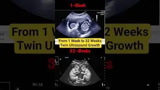 Twin Ultrasound: From 1 Week to 32 Weeks | Baby Development Journey