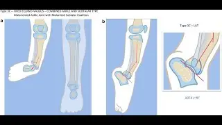 fibular hemimelia; long bone deficiency, partial or complete absence of the fibula