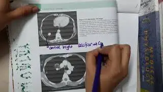 Coin Lesion of Lung mp4