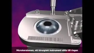 &Ouml;gonlaser Lasik Operation