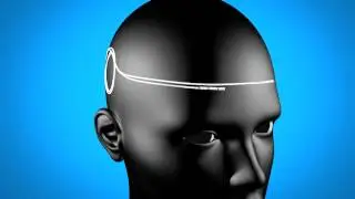 The Reed Procedure for Migraine & Headache Treatment Dallas Pain Specialist Dr. Ken Reed