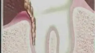 2- Les maladies de la gencive. (Vers microscopiques dans les gencives) Dr Mark Bonner