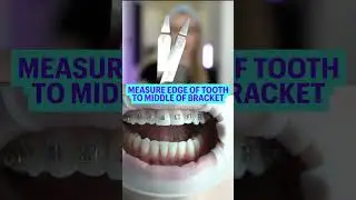How Braces Are Put On | Braces Colors