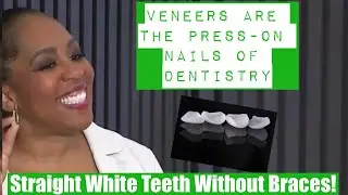 Achieve a Perfect Smile with Veneers: The Ultimate Quick Fix For Crooked Teeth!