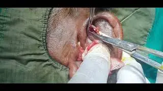 Perichondrial abscess pinna/Ear abscess/ Perichondritis of pinna incision drainage -Dr Hitesh Patel