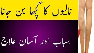 Varicose Veins Treatment In Urdu/Hinddi 2023 |  @IkOfficial448   | Nalion ka Guchha Ban jana