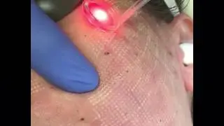 AcuPulse CO2 Laser!