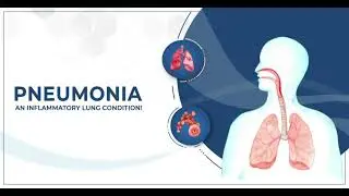 Pneumonia #pneumonia #knowledge #medicalstudent  #medical #subscribe