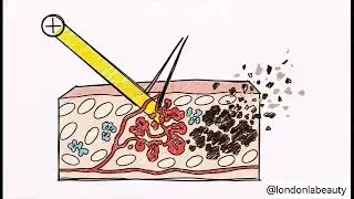 Laser energy-based devices focus on skin restoration, acne management, and rejuvenation.