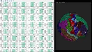 Somatosensory Evoked Potentials (SSEP) recorded in g.HIsys Professional Software