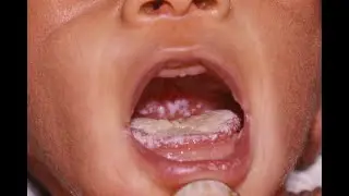 Madaa’uu afaanii fangasiin dhufu (Oral candidiasis)!