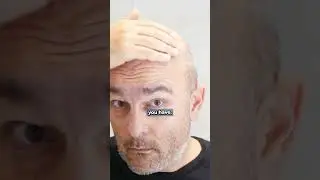 Are 3000 Grafts too Many?