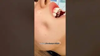 How Dimple Surgery Works 😲#short #dimpleplasty - Creativelearning3d