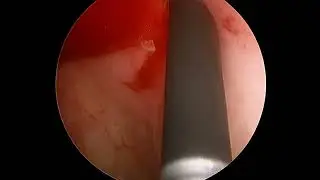 Cystoscopy, DJ Stenting & DJ Stent Removal