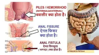 बवासीर, फ़िशर, फिस्चुला (भगन्दर) में क्या अन्तर होता है । Piles, Fissure & Fistula #haemorrhoids 