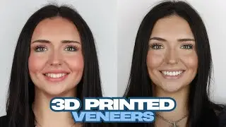 3D Printed Prepless Veneer Process
