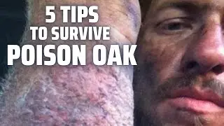5 best tips to avoid poison oak rash - poison ivy and poison sumac cure and remedy