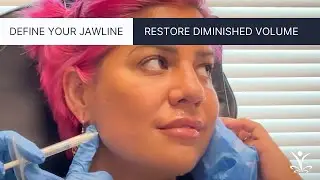 Define Your Jawline with Dermal Filler