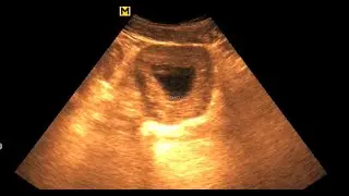 Chronic Cystitis || Thickened Urinary Bladder Wall || Sonographic Prediction of cystitis