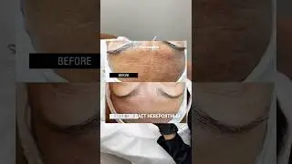 Процедура которая изменит твою кожу| HESPERA ➡️079906003 #botox #skincare #красотаназдоровье