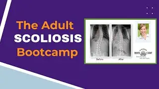 The Adult Scoliosis Bootcamp #Bootcamp #AdultScoliosis #scolismart #scoliosistreatment