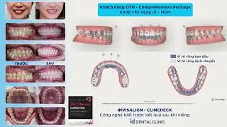 H&agrave;m M&oacute;m | Invisalign ClinCheck id Dental Clinic