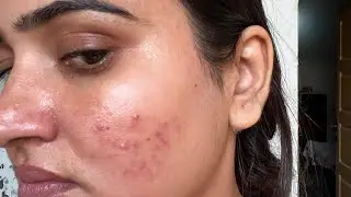 SQUALANE SKINCARE ROUTINE for Skin Barrier Recovery | Fix Damaged Skin Barrier Naturaly
