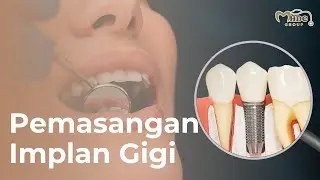 Animasi Proses Pemasangan Gigi Palsu Permanen Implan Gigi