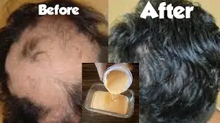 Apply this just Once A Week & Your Hair WON'T Stop Growing! How To Grow Thicker and Longer Hair Fast