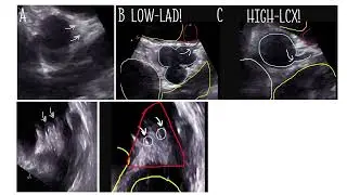 Absence of the left main coronary artery &ndash; the most common anatomical variant.