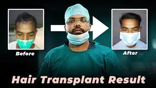 Hair Transplant Surgery Result | Hair Loss Treatment