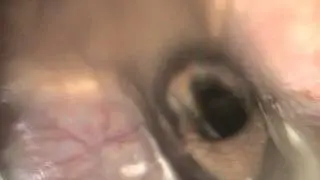 Videoendoscopy 15 Jahrige Wallach