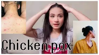 Chicken pox 😭😔||kisko naa ho||#janglistyle