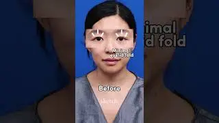 Eyelids giving you trouble? | Sketch Plastic Surgery #shorts