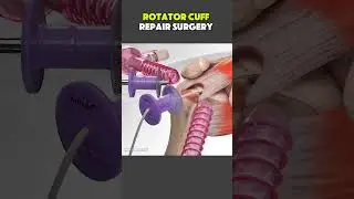 Torn Rotator Cuff Repair Surgery Explained | Orthopedic Procedure  #orthopedicsurgery#shoulder