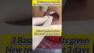basal implants miracle l New teeth in 3 days l Quality Eating possible l fix teeth #basalimplants