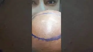 # hair transplant @ micro fue method surgery #hairsurgeon # sapphire blade#